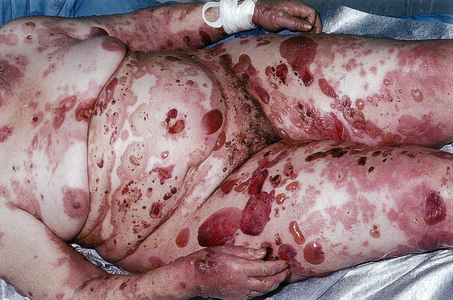 Bullous pemphigoid