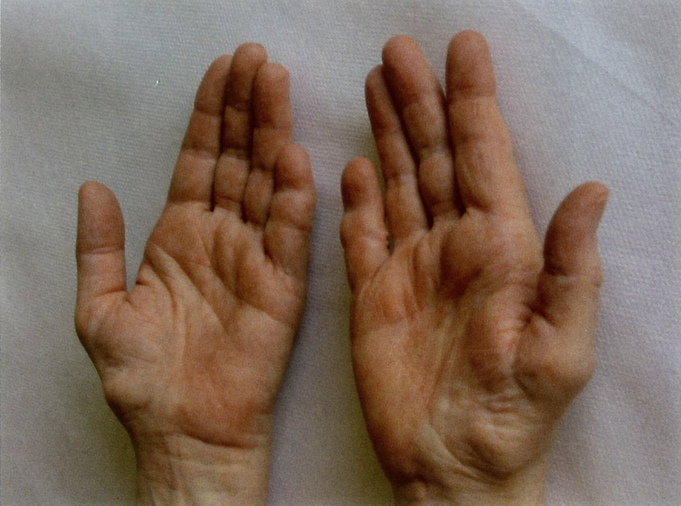 Thenar atrophy secondary to median nerve injury