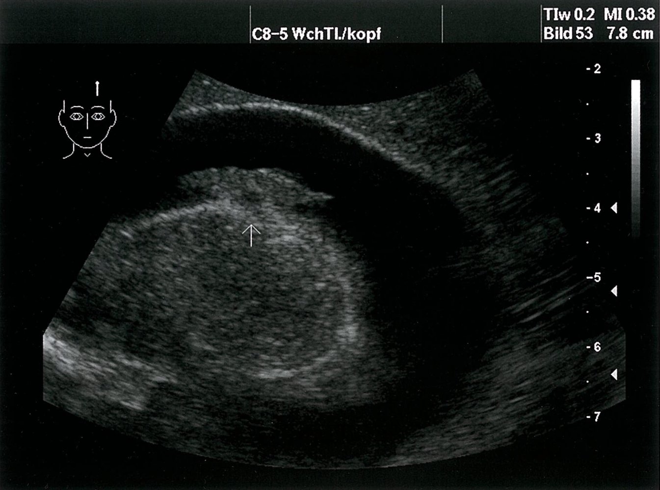 Congenital CMV infection