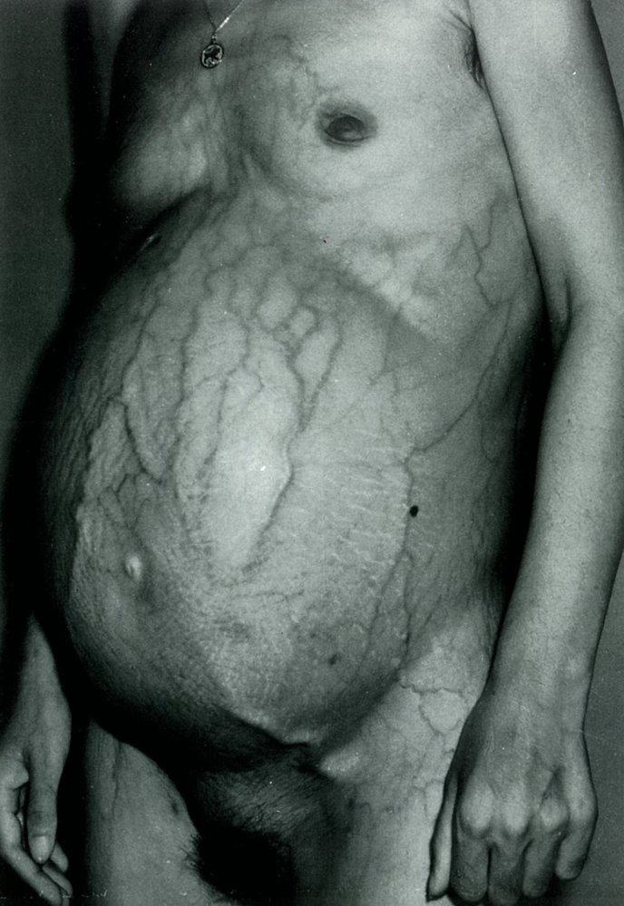 Caput medusae and ascites