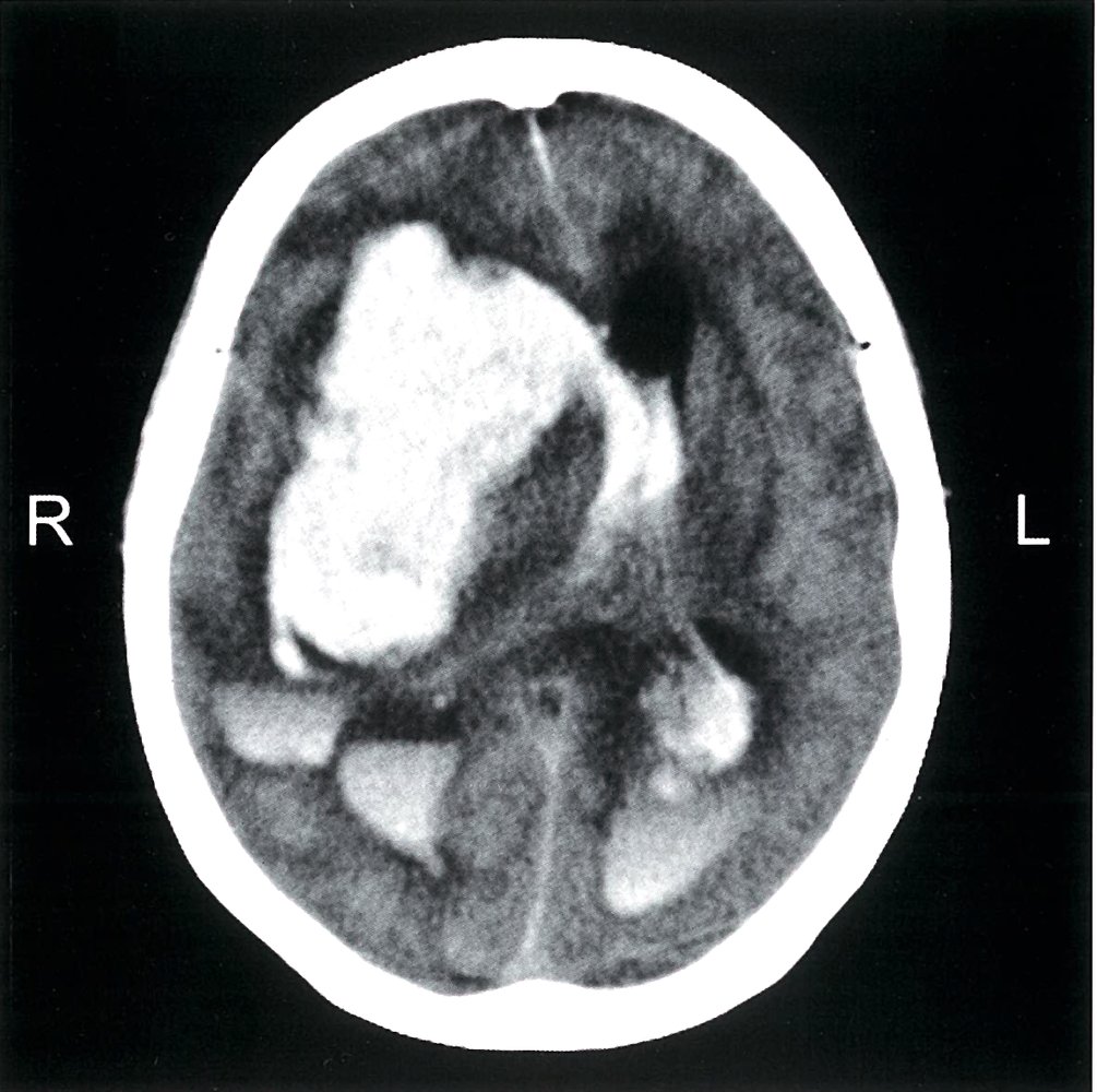 Basal ganglia hemorrhage
