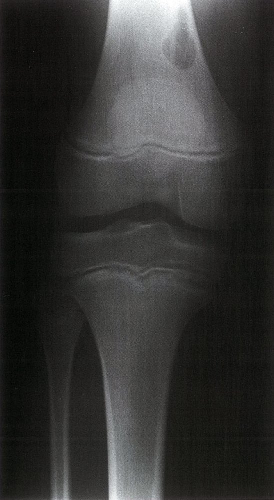 Nonossifying fibroma