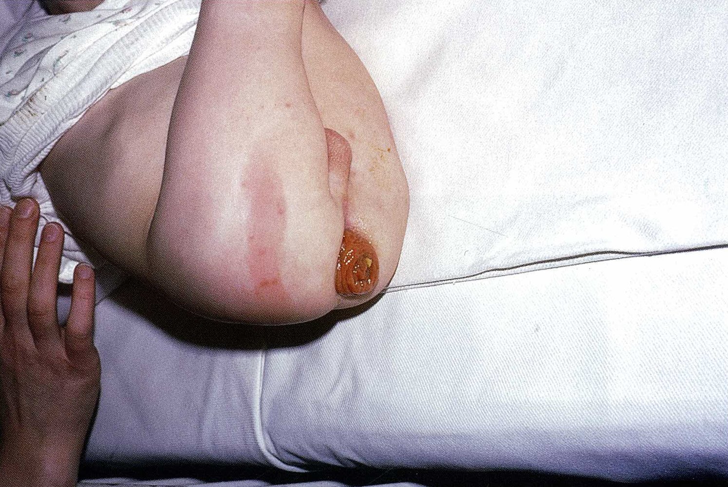 Rectal prolapse in cystic fibrosis