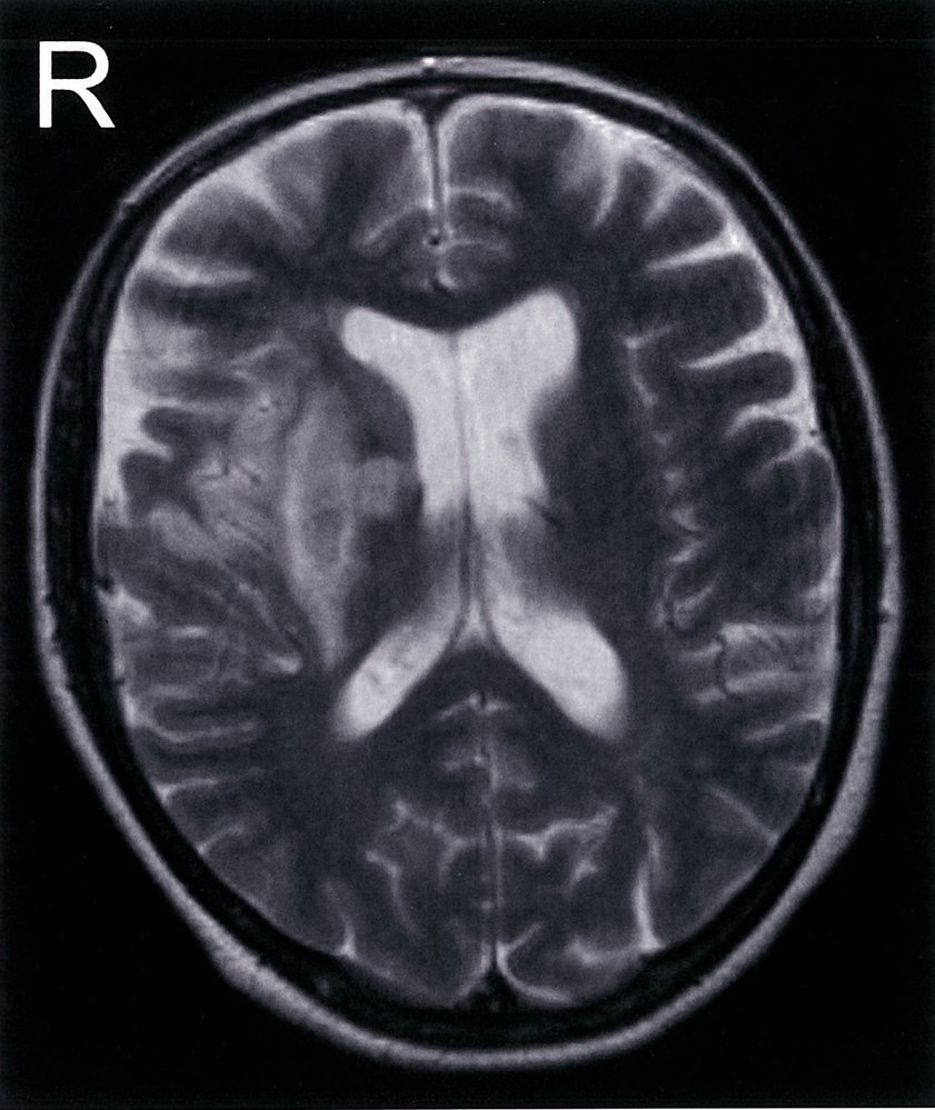 Right middle cerebral artery infarction