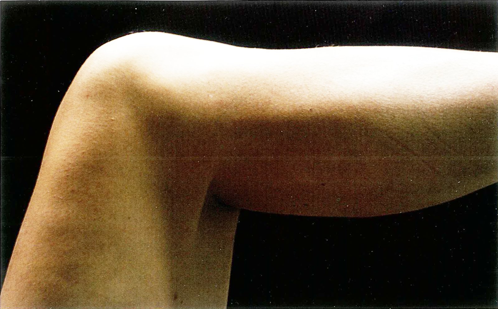 Posterior sag sign (knee joint)