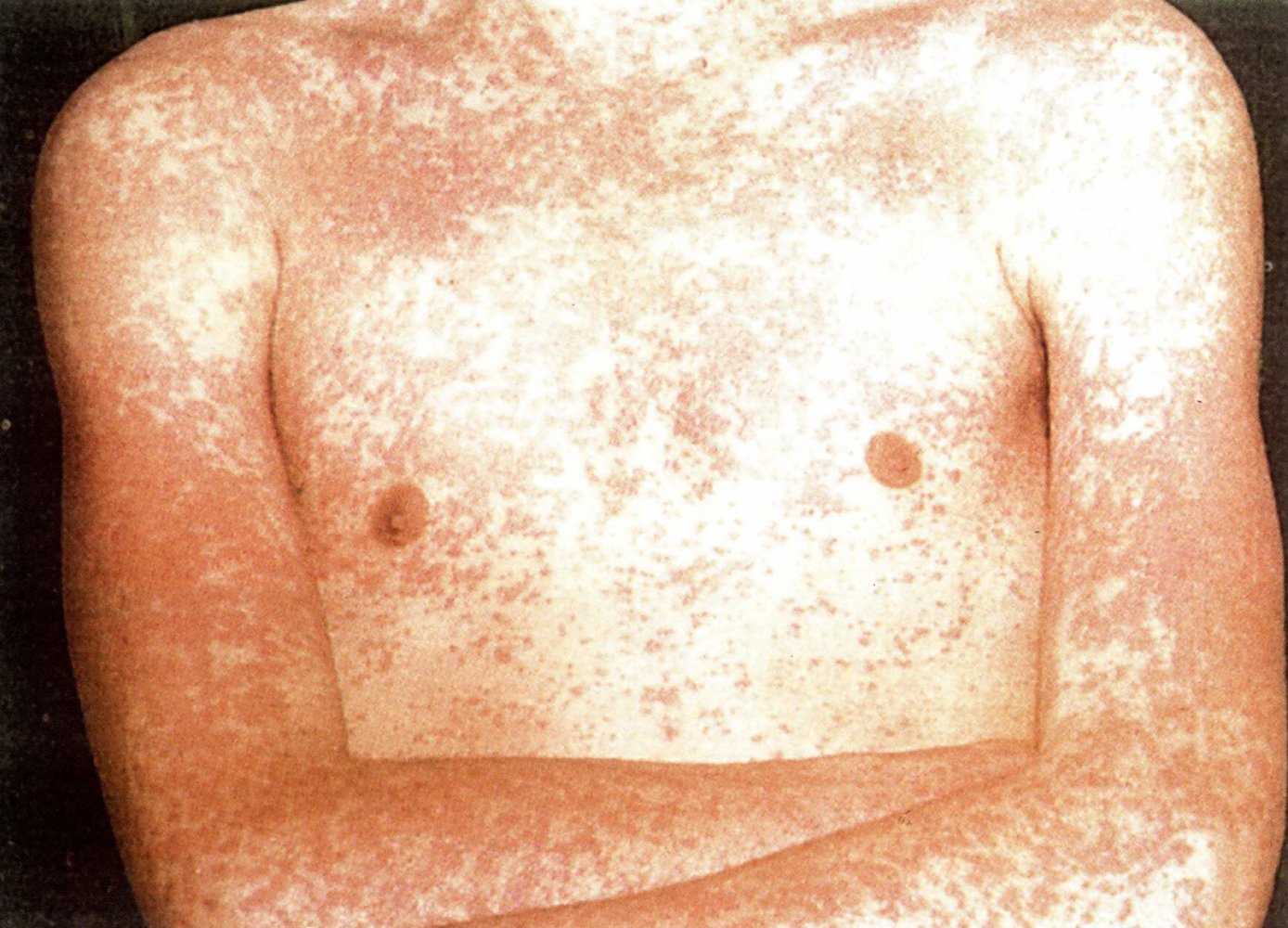Aminopenicillin-related exanthem in infectious mononucleosis