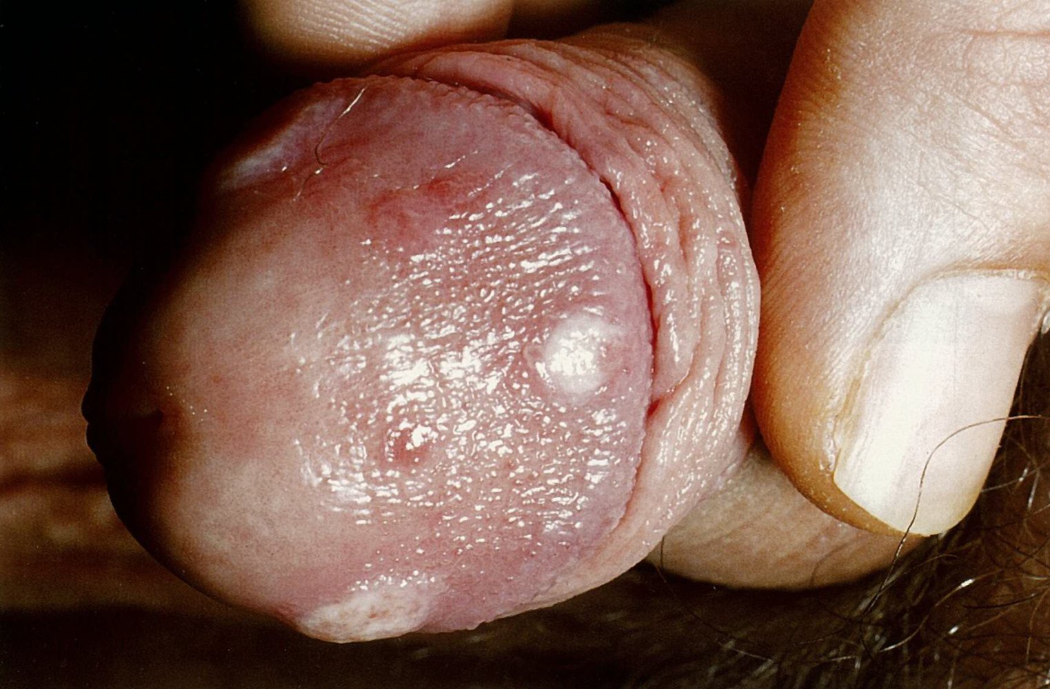 Condylomata lata of the glans penis in secondary syphilis