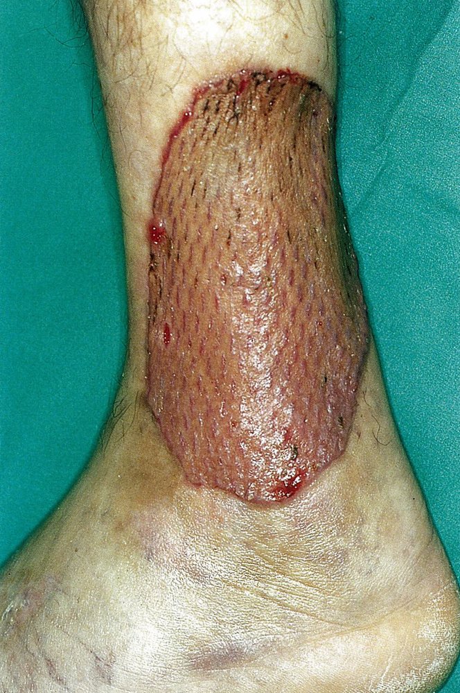 Excized venous ulcer with a split-thickness skin graft using mesh grafting
