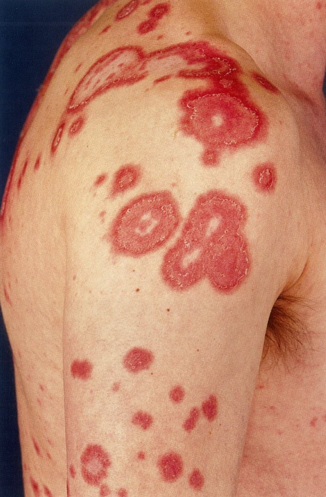 Subacute cutaneous lupus erythematosus