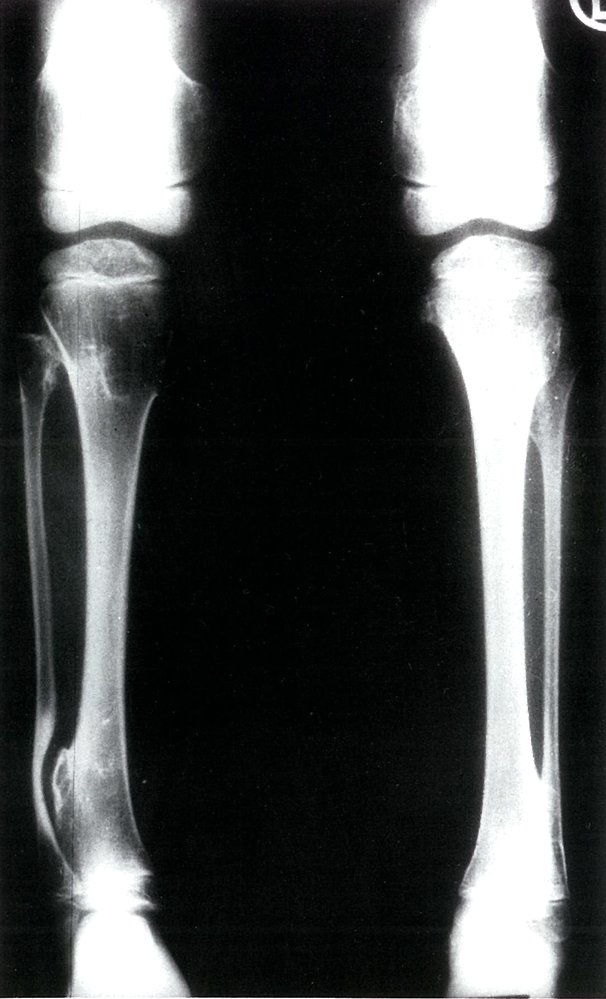Osteochondroma