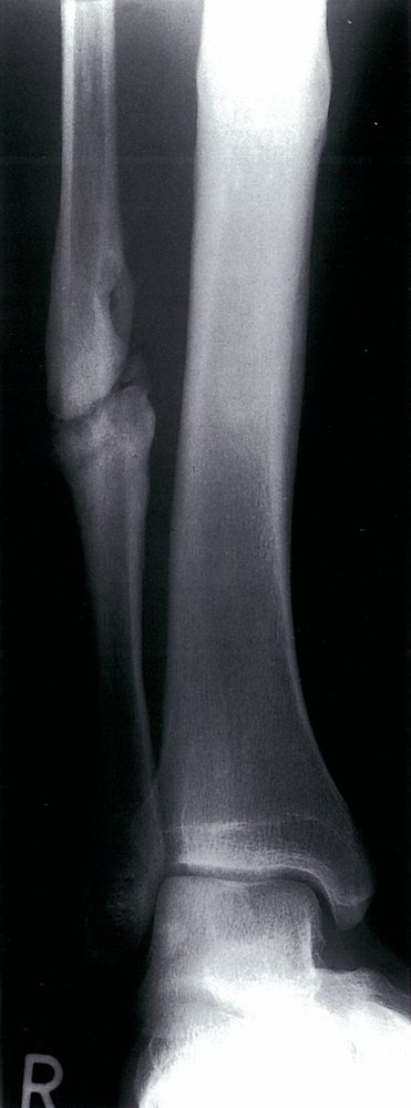 Hypertrophic pseudarthrosis of the distal fibula