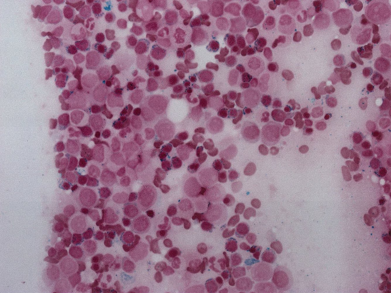 Acute leukemia in myelodysplastic syndrome