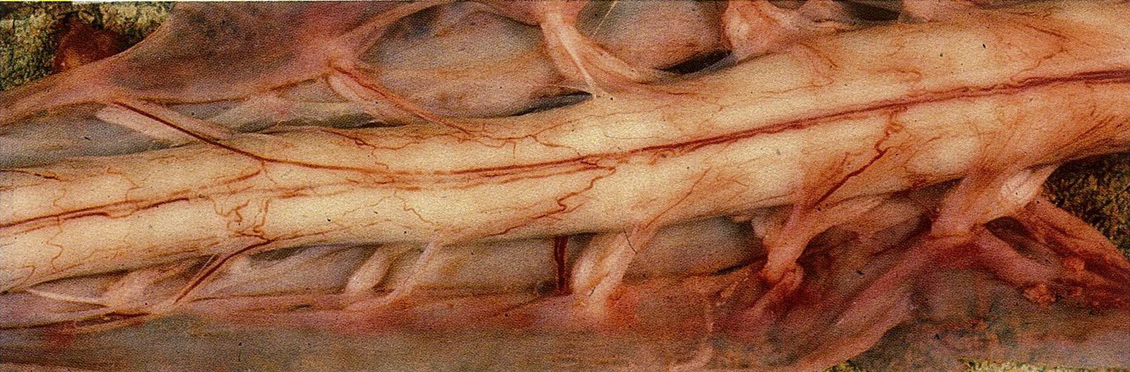 Amyotrophic lateral sclerosis