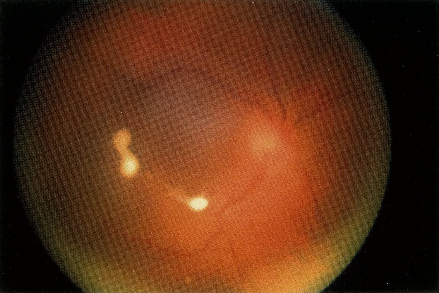 Fungal endophthalmitis