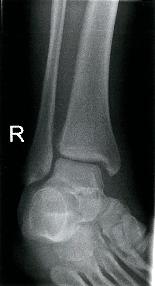 Ankle mortise separation
