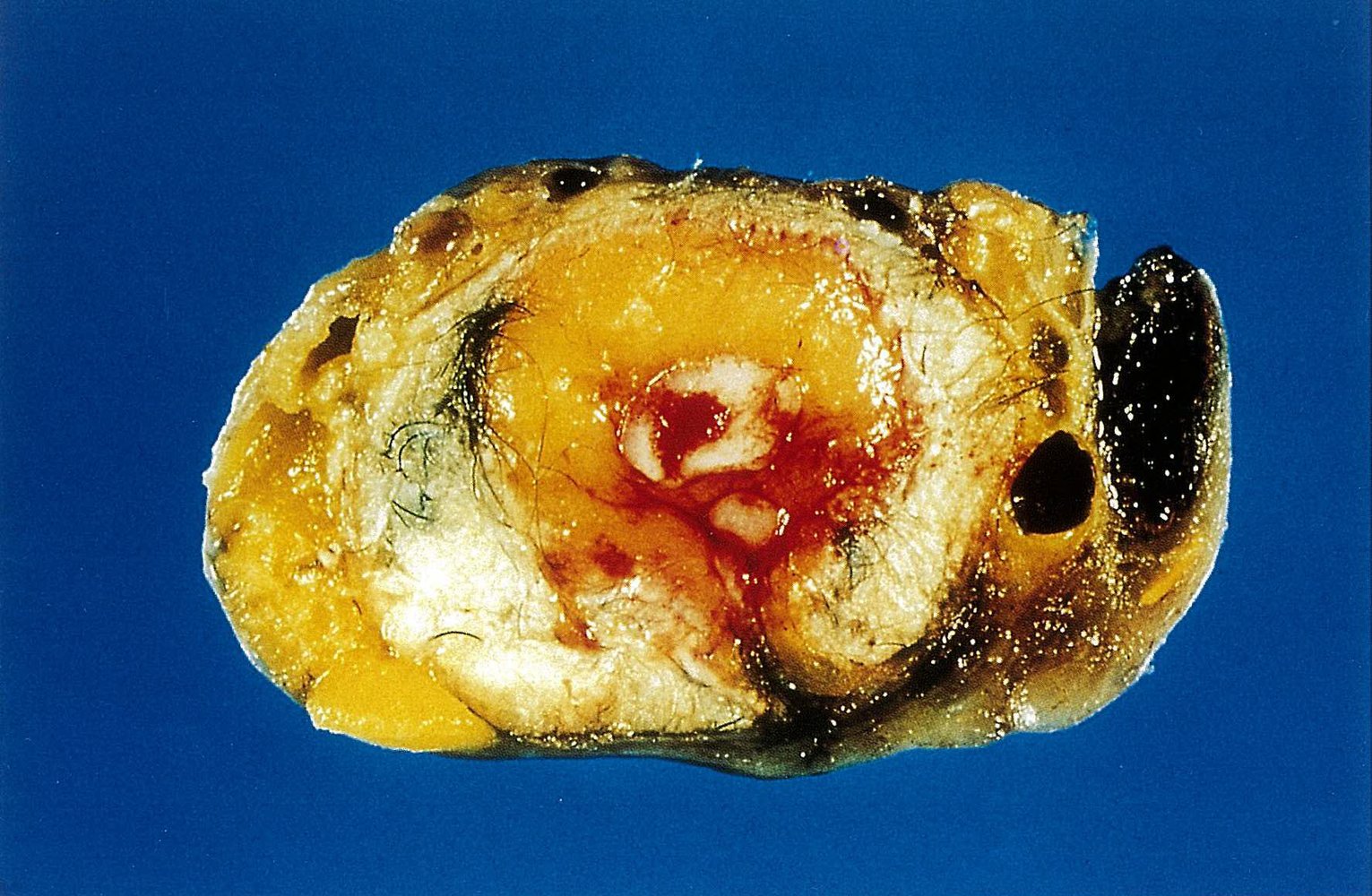 Dermoid cyst (mature teratoma)