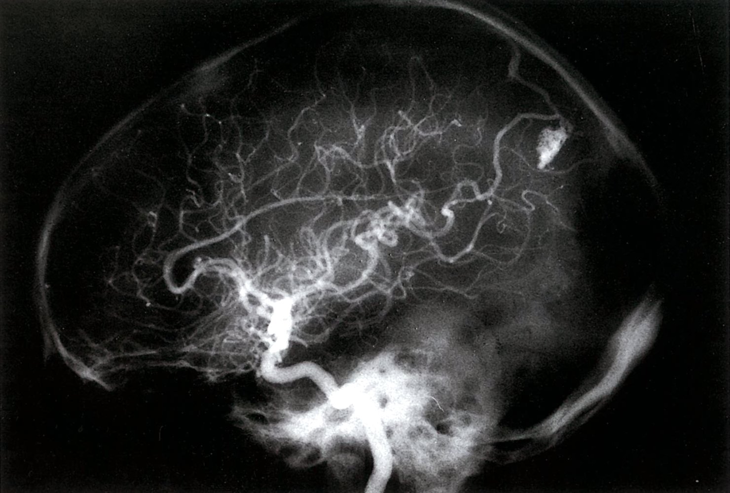 Arteriovenous malformation (angioma)