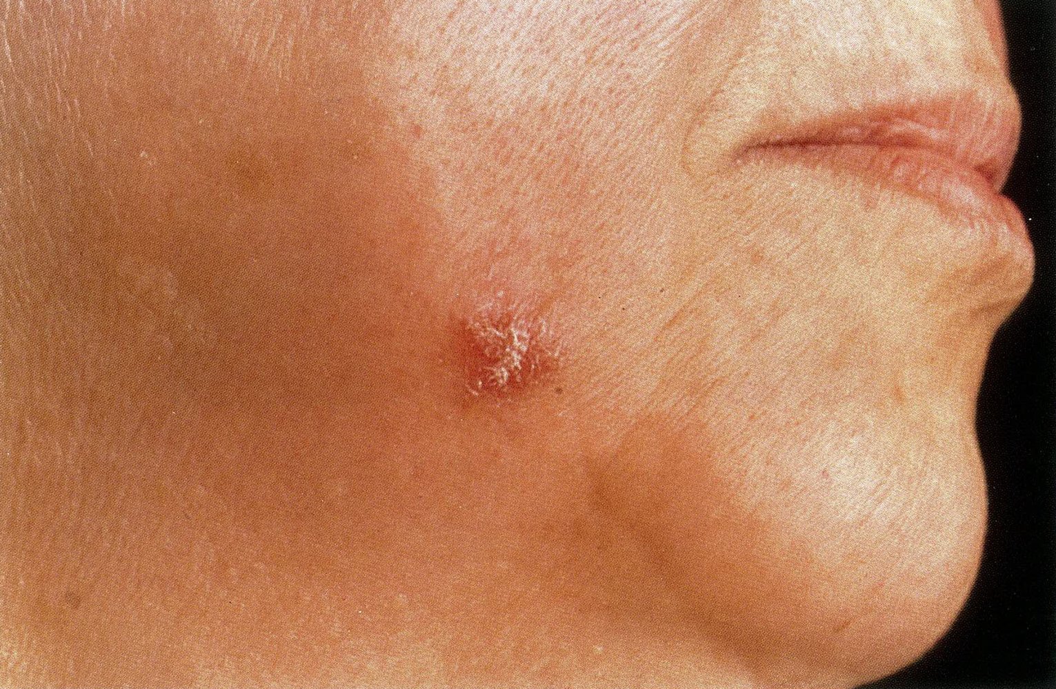 Dermatological tuberculosis - lupus vulgaris