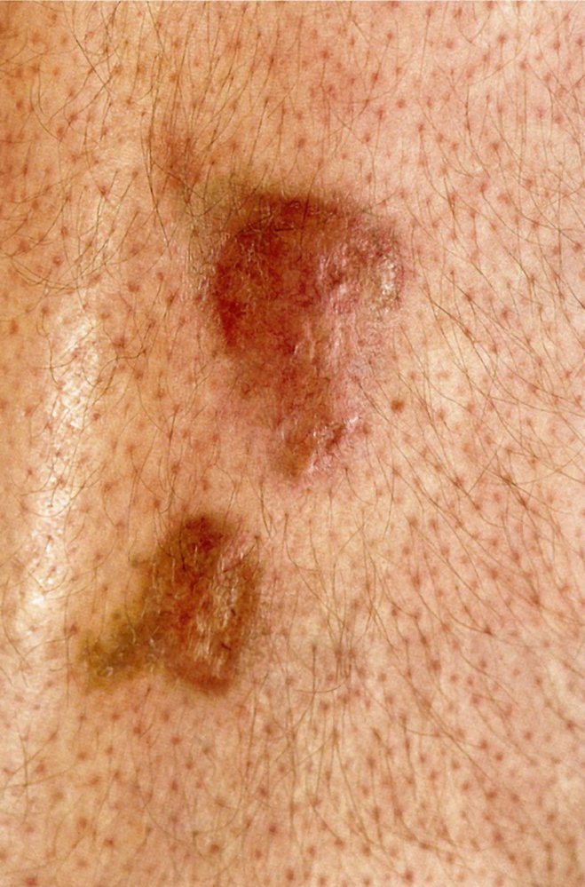 Necrobiosis lipoidica
