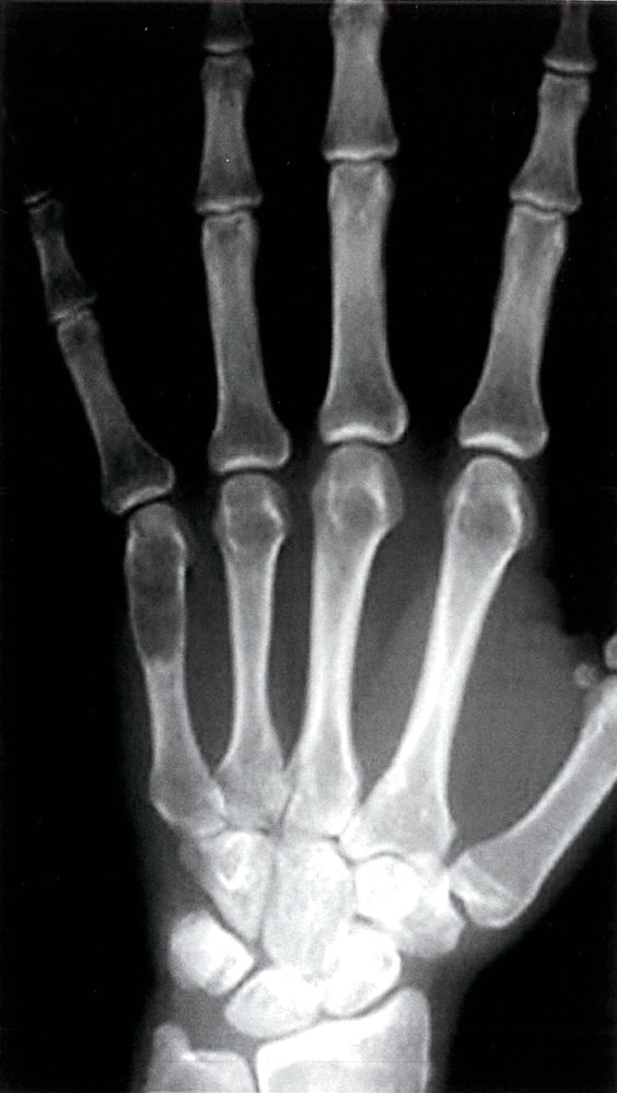 Enchondroma of the fifth metacarpal of the left hand