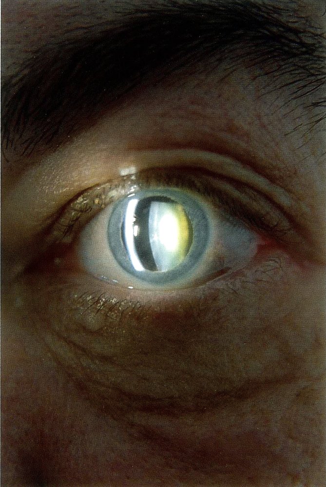 Cataract