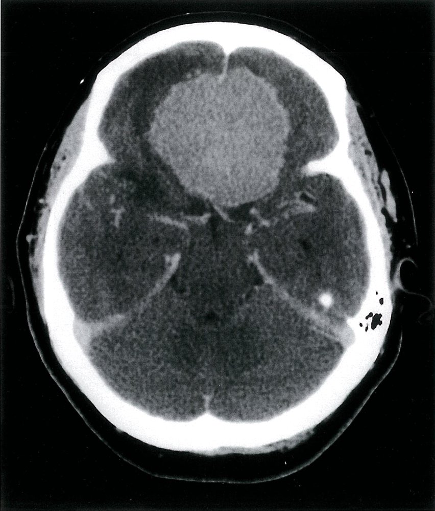 Olfactory groove meningioma