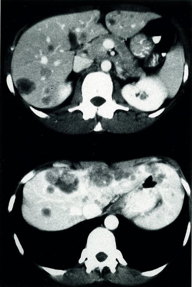 Liver metastases