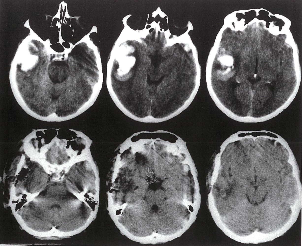 Intracerebral hemorrhage