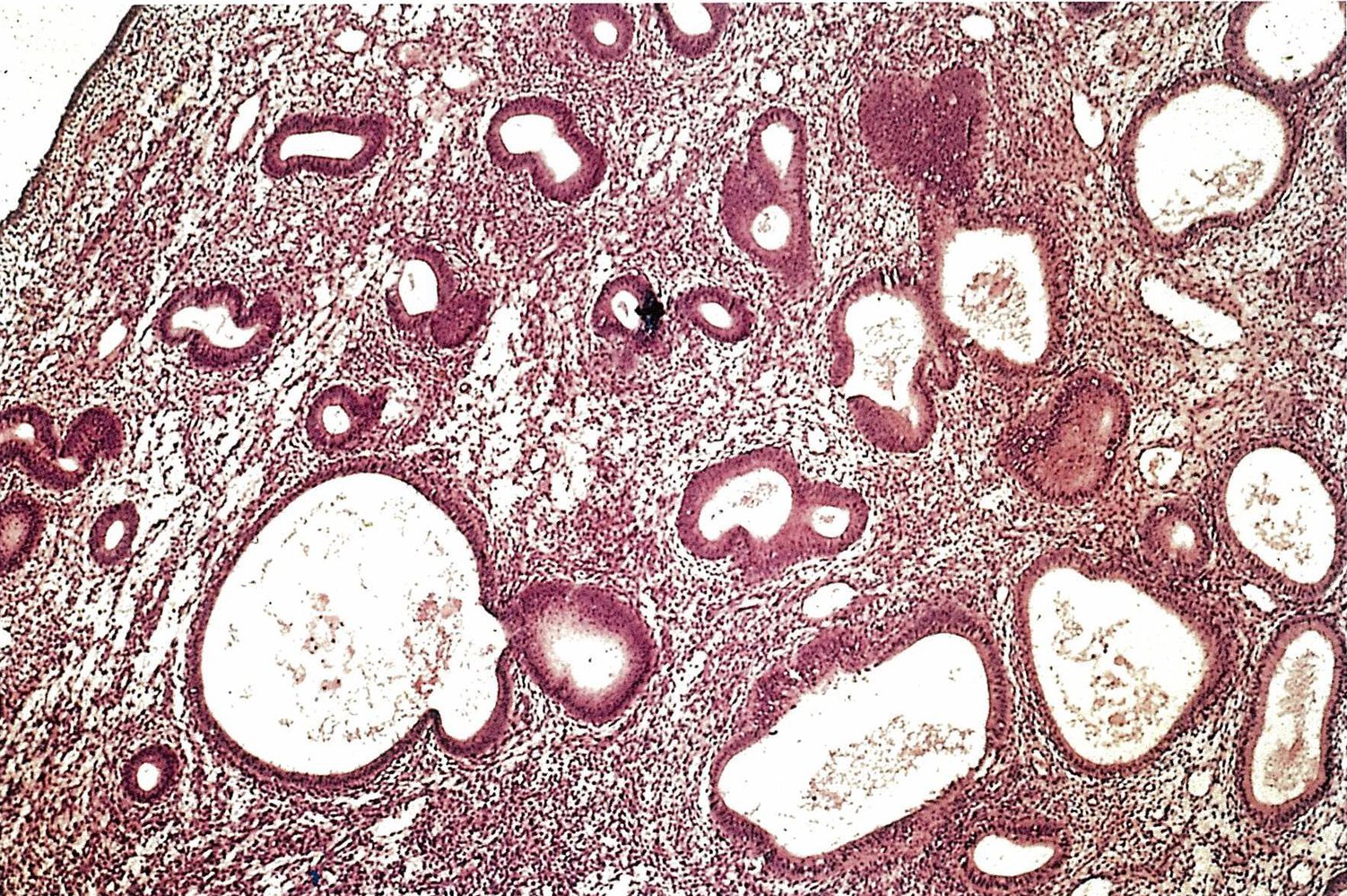 Glandular cystic, simple endometrial hyperplasia
