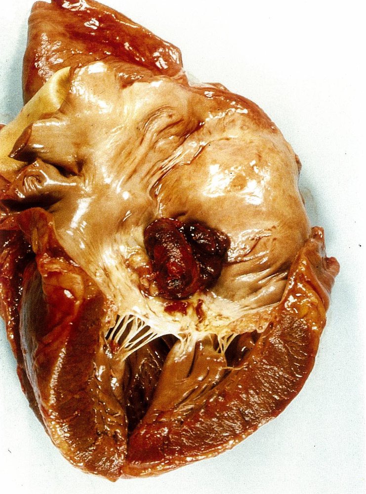 Thrombus in left atrium