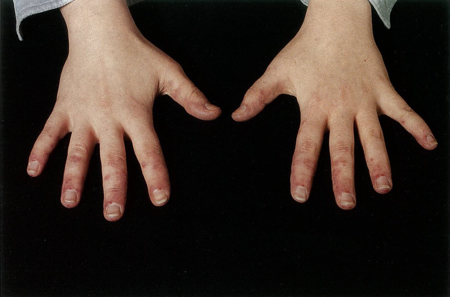 Periungual telangiectasia in systemic lupus erythematosus