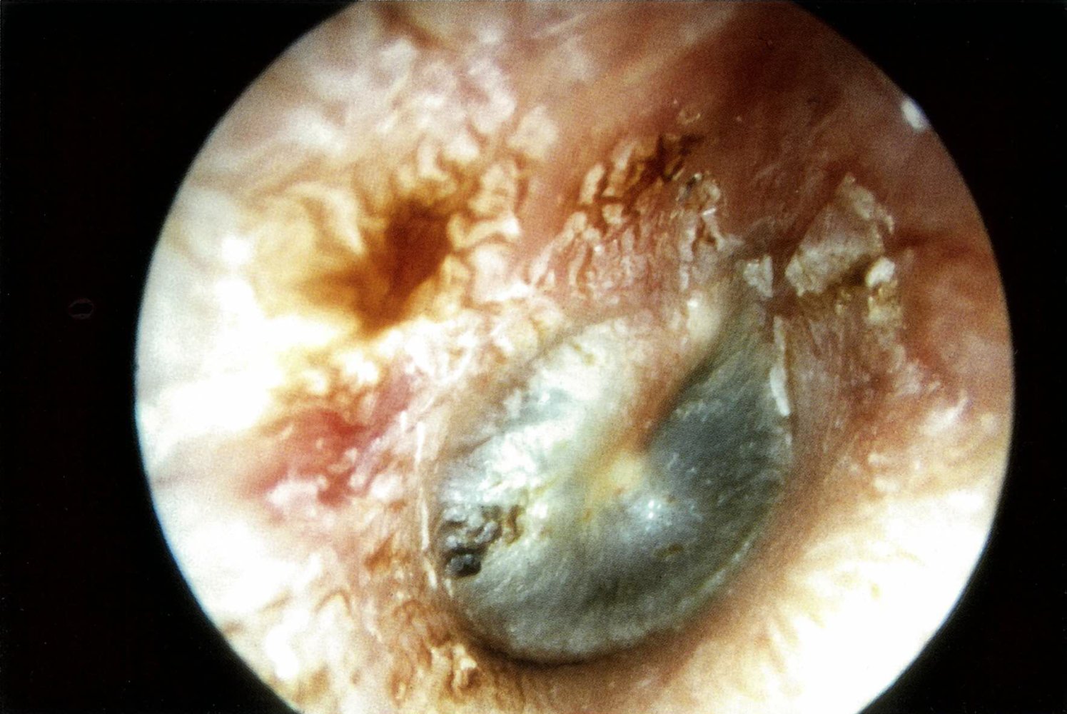 Hemotympanum