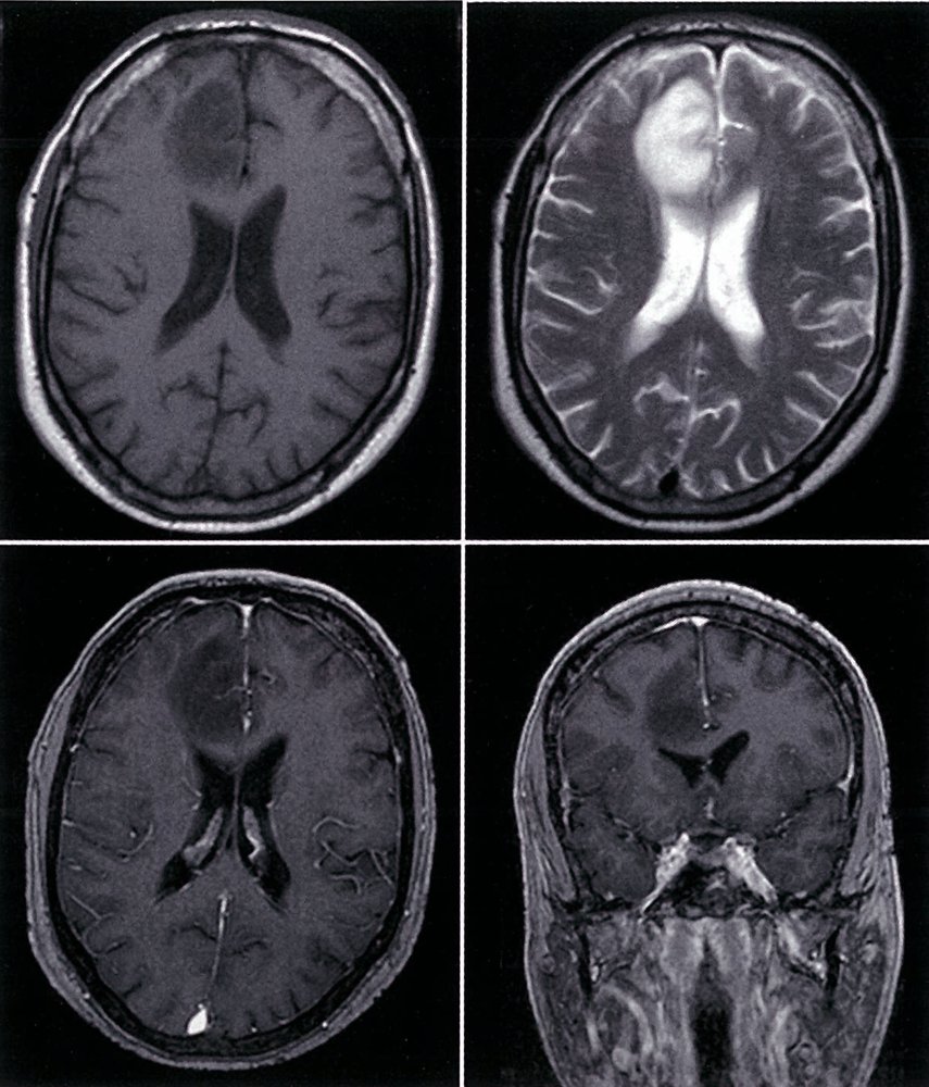 Low-grade glioma