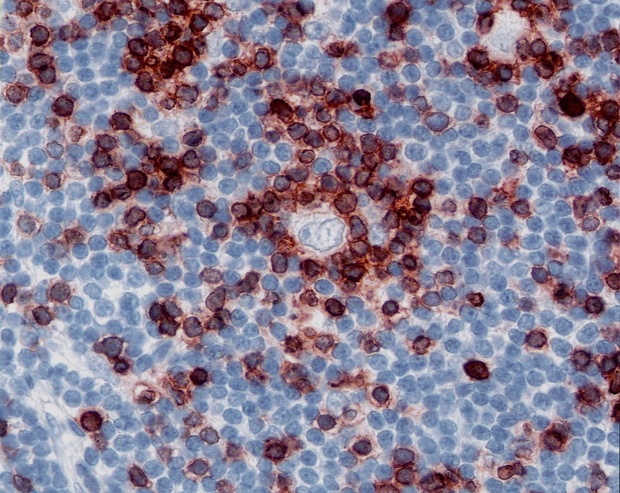 Hodgkin lymphoma