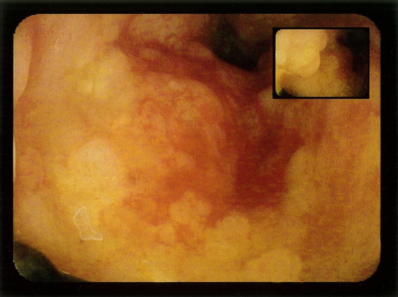 Active ulcerative colitis