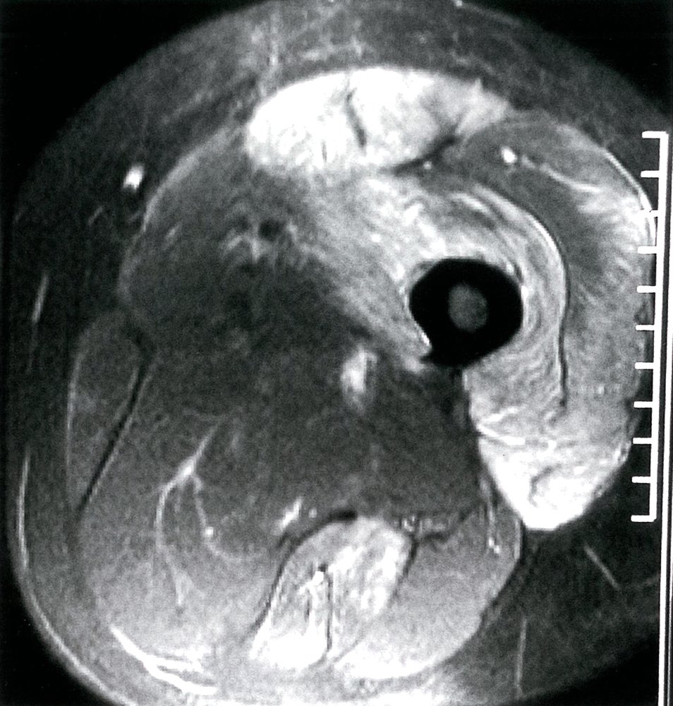 Dermatomyositis