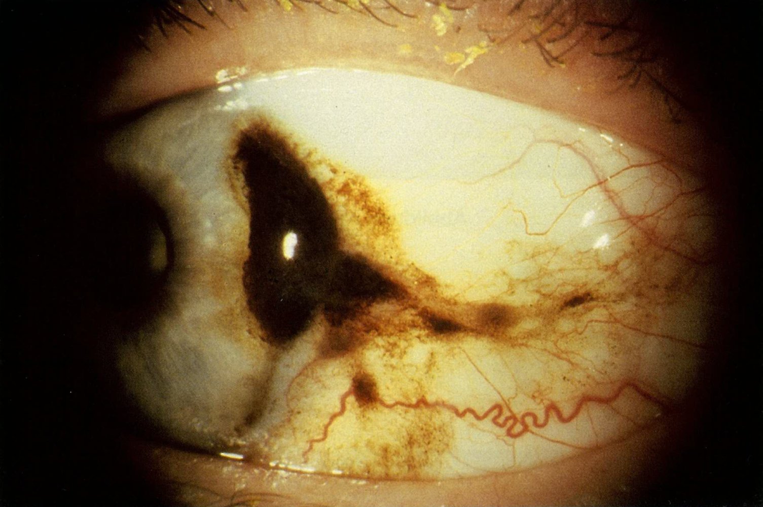Conjunctival melanoma