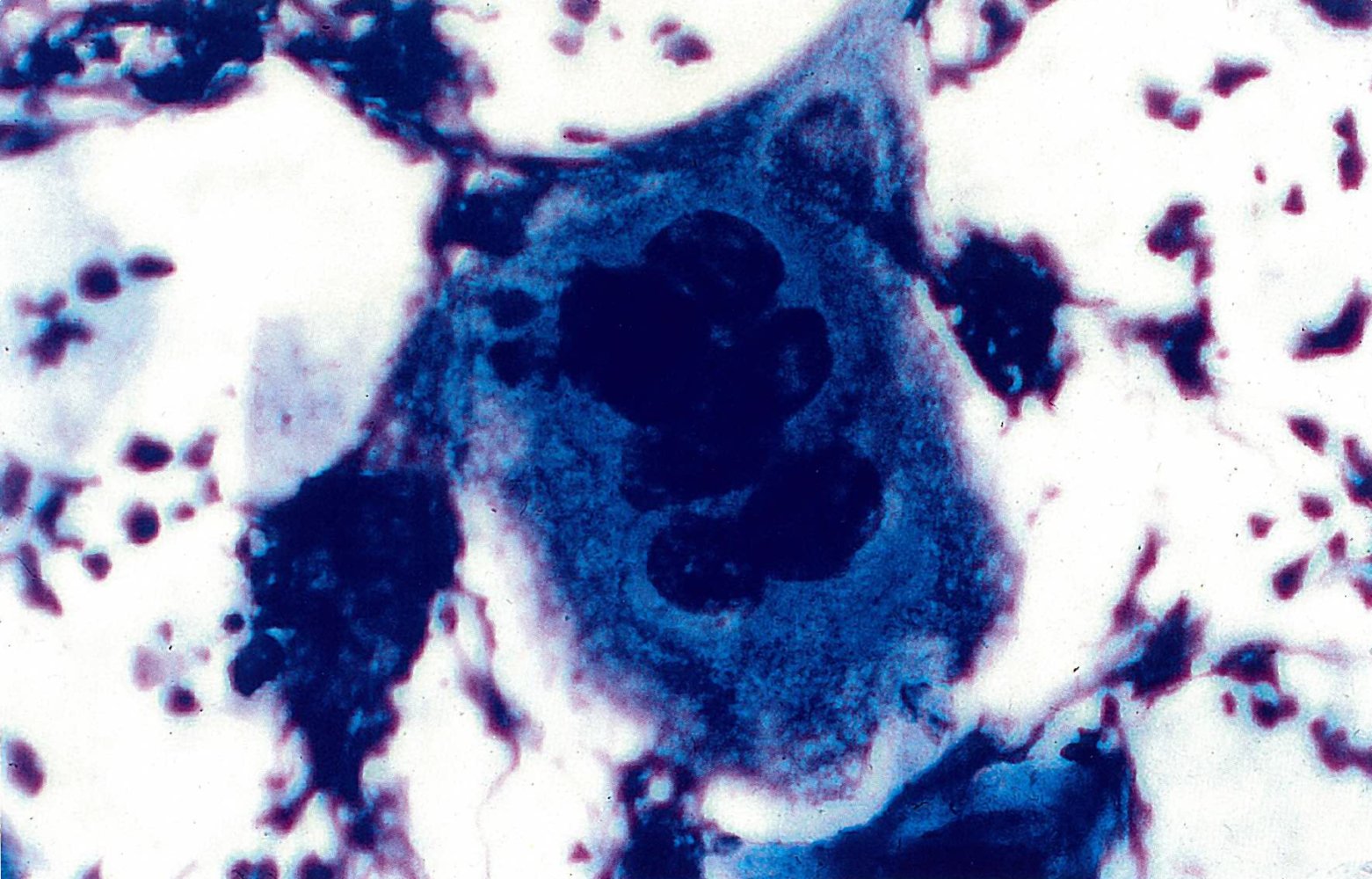 Tzanck cell