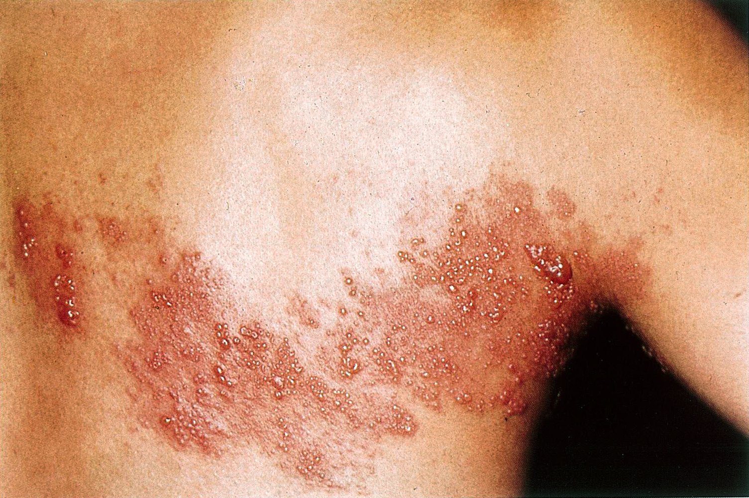 Shingles