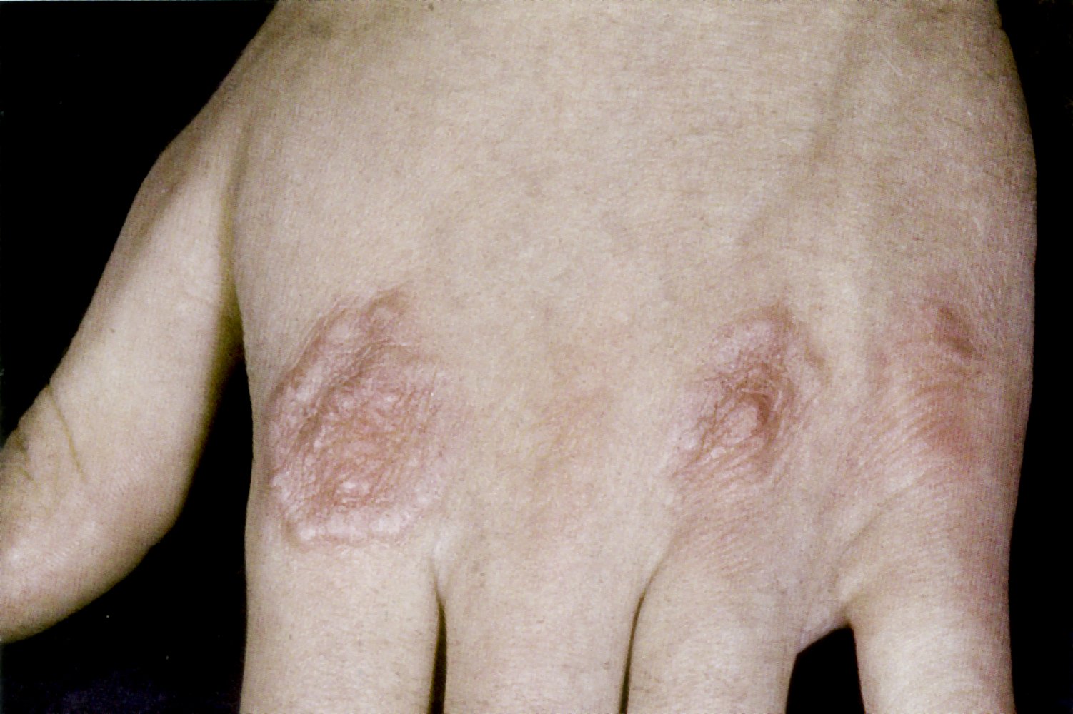 Granuloma annulare