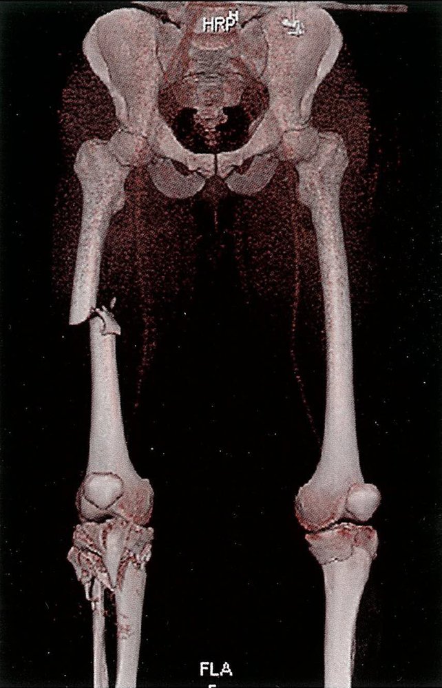 Right femoral shaft fracture and bilateral tibial plateau fracture (3D CT reconstruction)