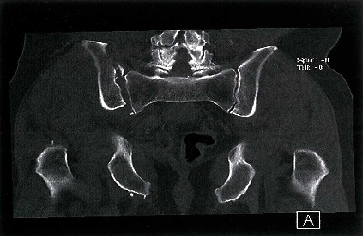 Posterior pelvic ring fracture