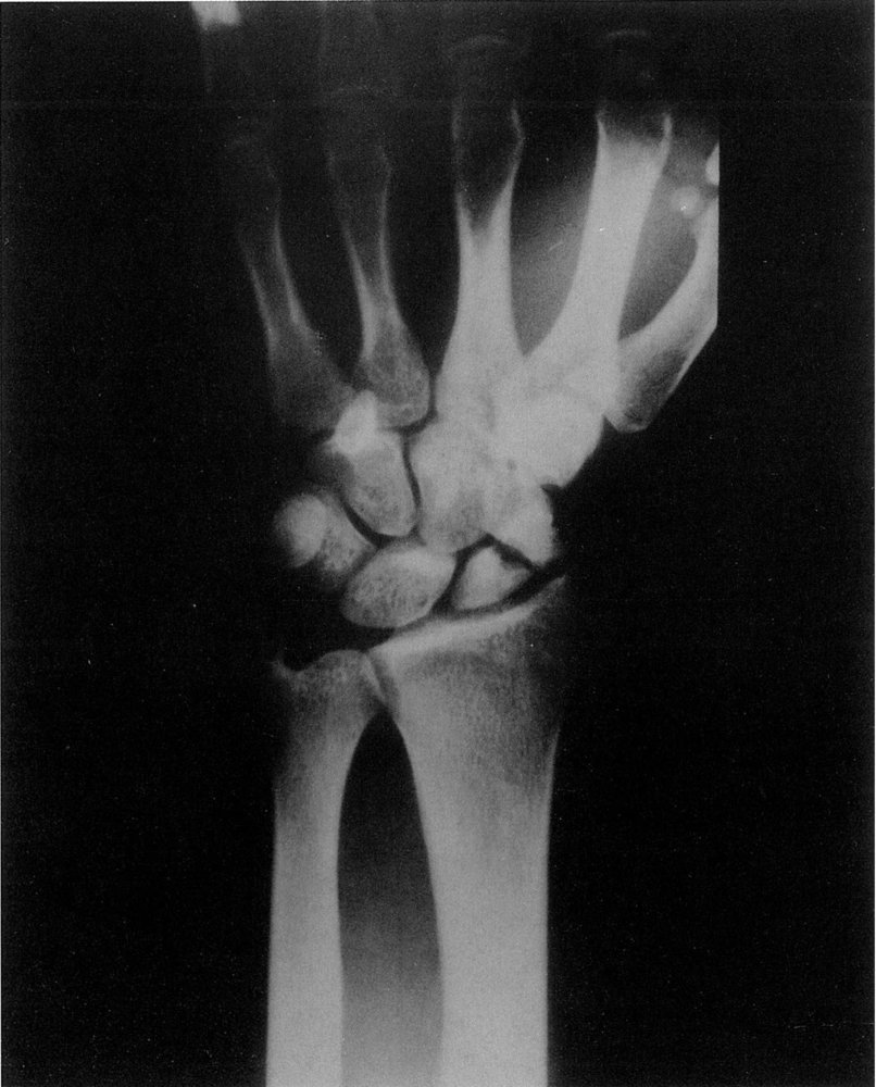 Scaphoid pseudarthrosis