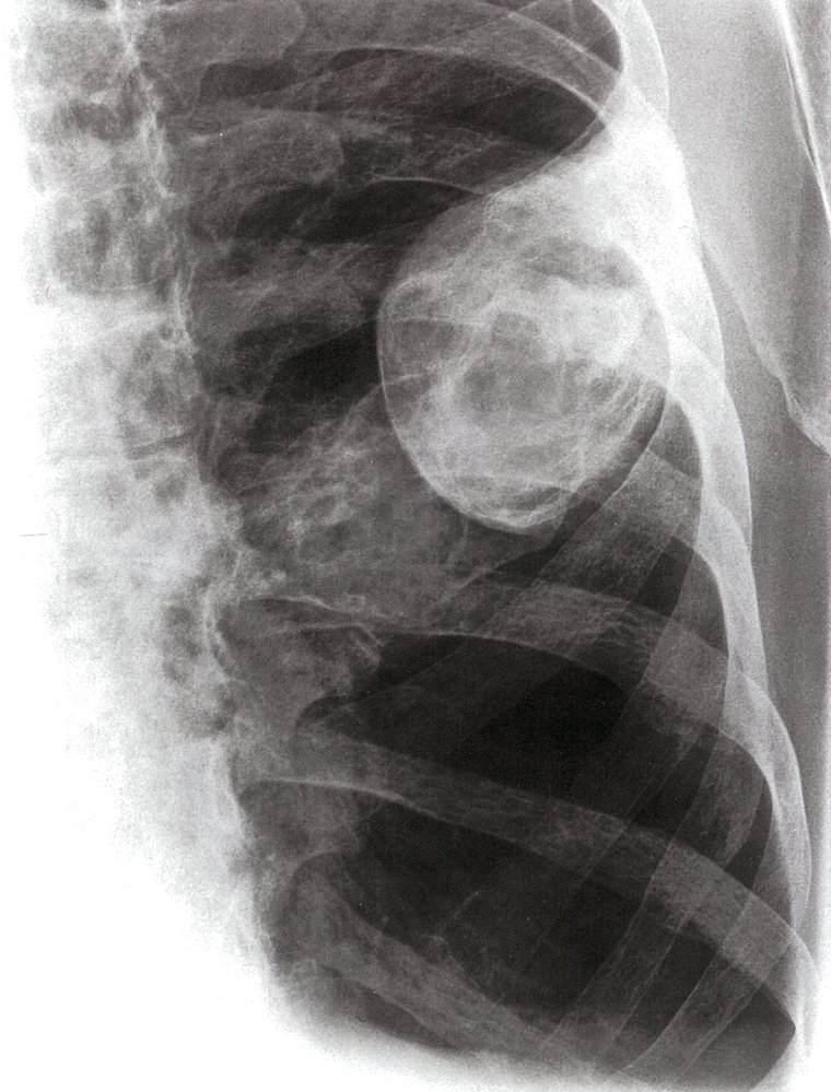 Osteochondroma