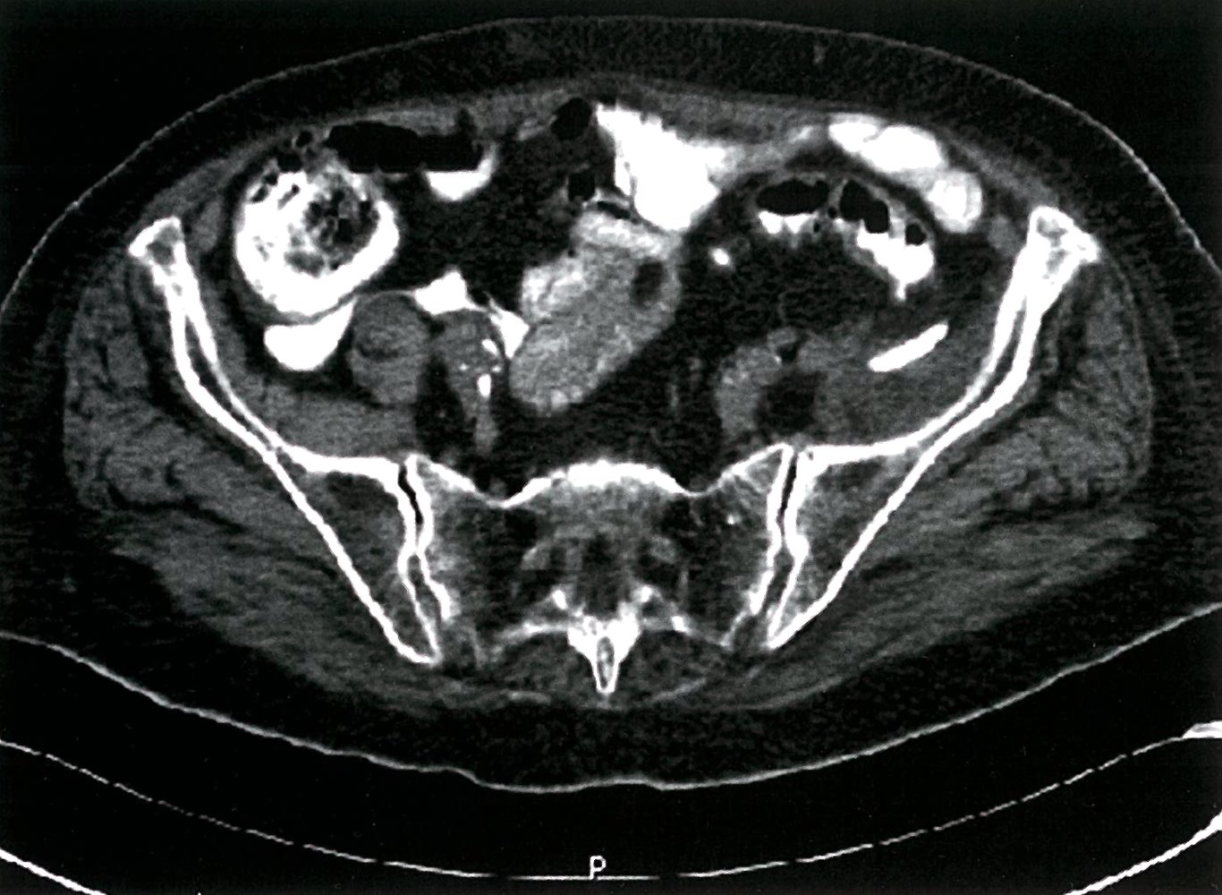 Perforated diverticulitis