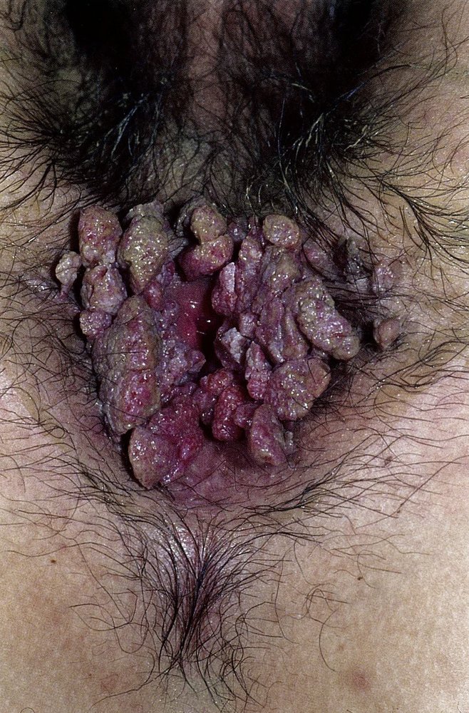 Anogenital warts (condylomata acuminata)