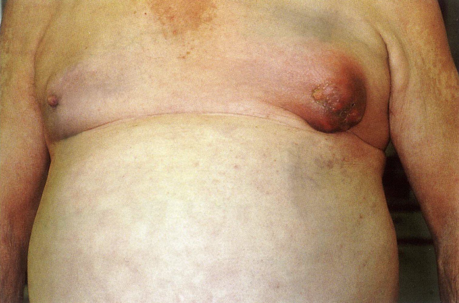 Inflammatory breast cancer