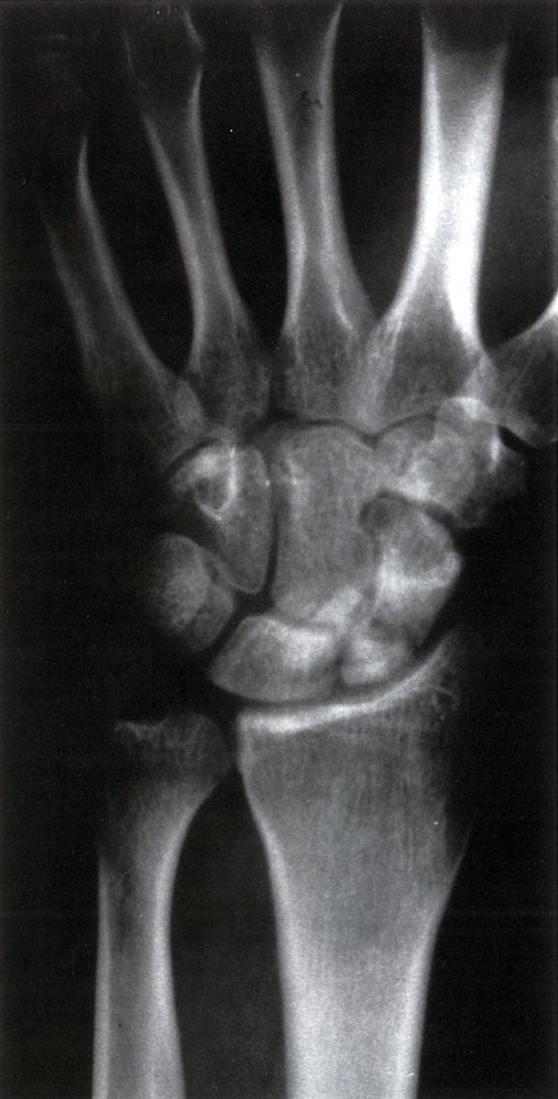 Scaphoid fracture