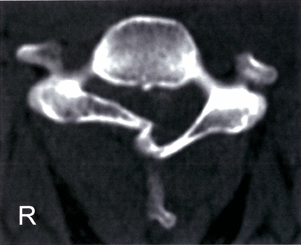 Vertebral arch fracture deformity with spinal stenosis