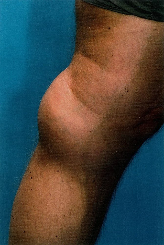 Popliteal (Baker) cyst